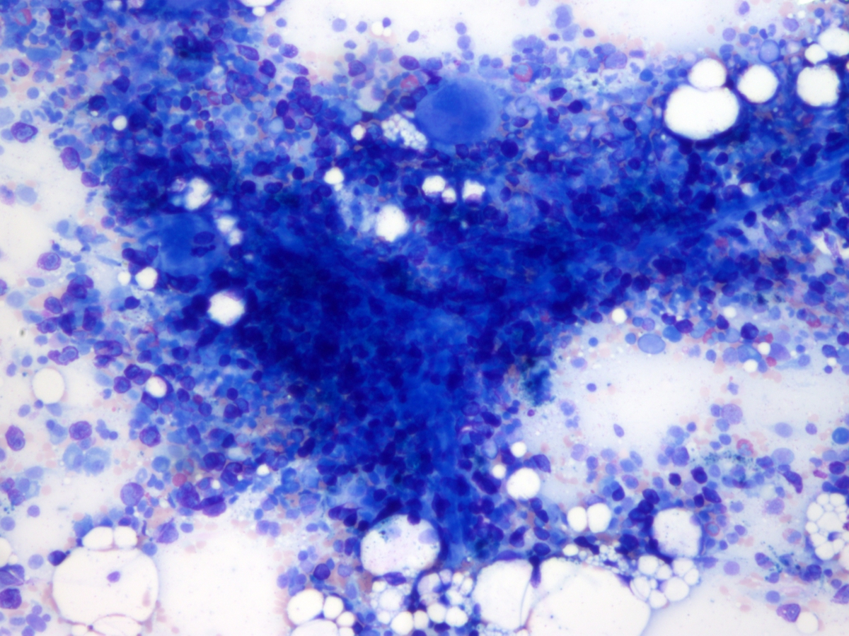 Day 28 bone marrow aspirate showing mast cells